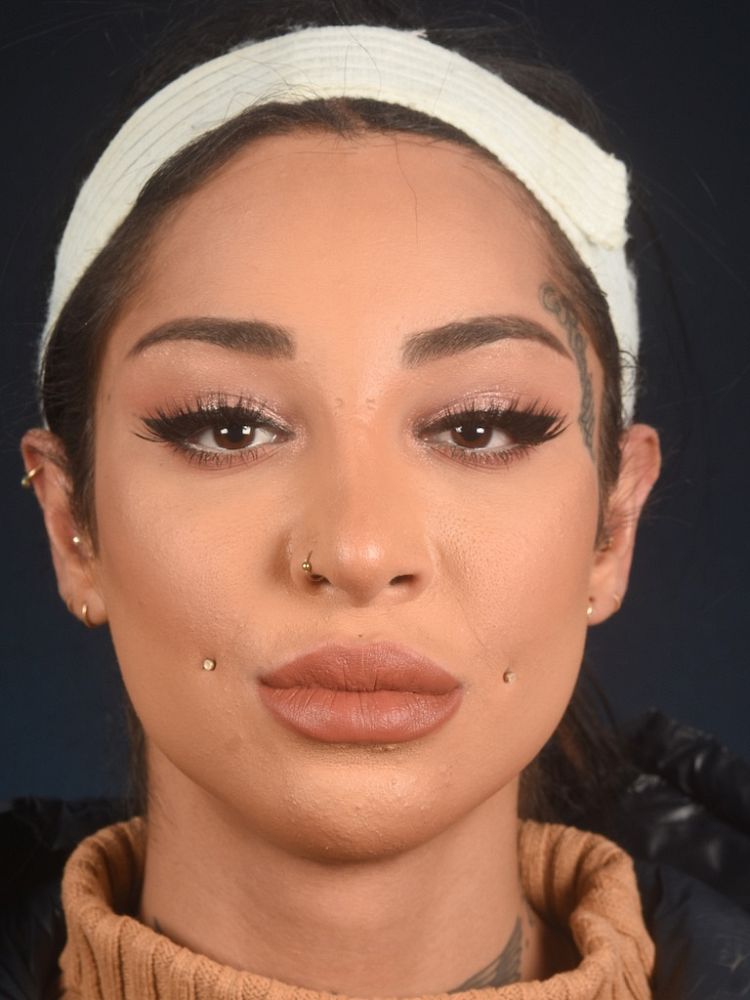 Facial Feminization Surgery