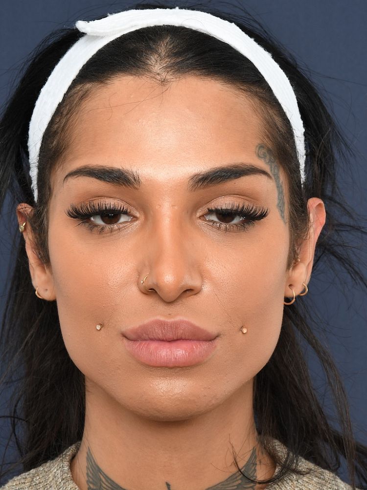 Facial Feminization Surgery