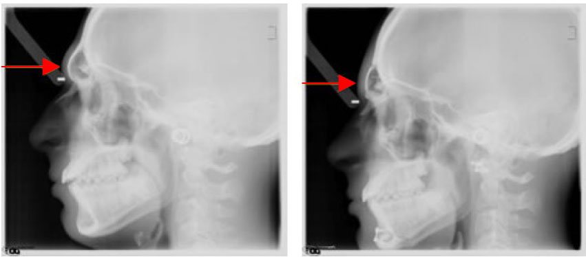 x-ray foreah recontouring