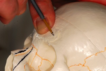 Recontouring voorhoofd