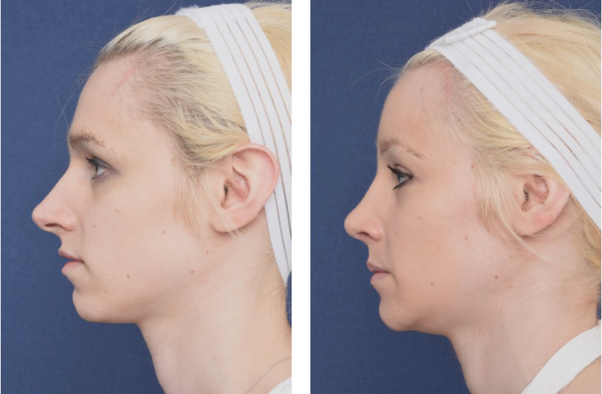 Before and after brow bone reduction and forehead recontouring type 1