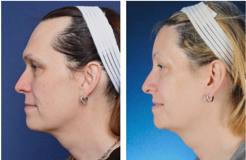 before and after - voor en na forehead recontouring, voorhoofd remodellering