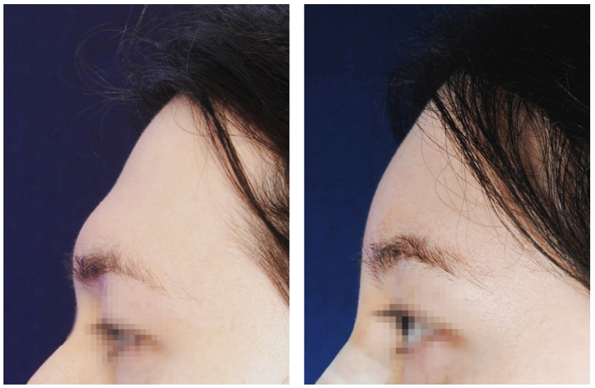 brow bone reduction before and after