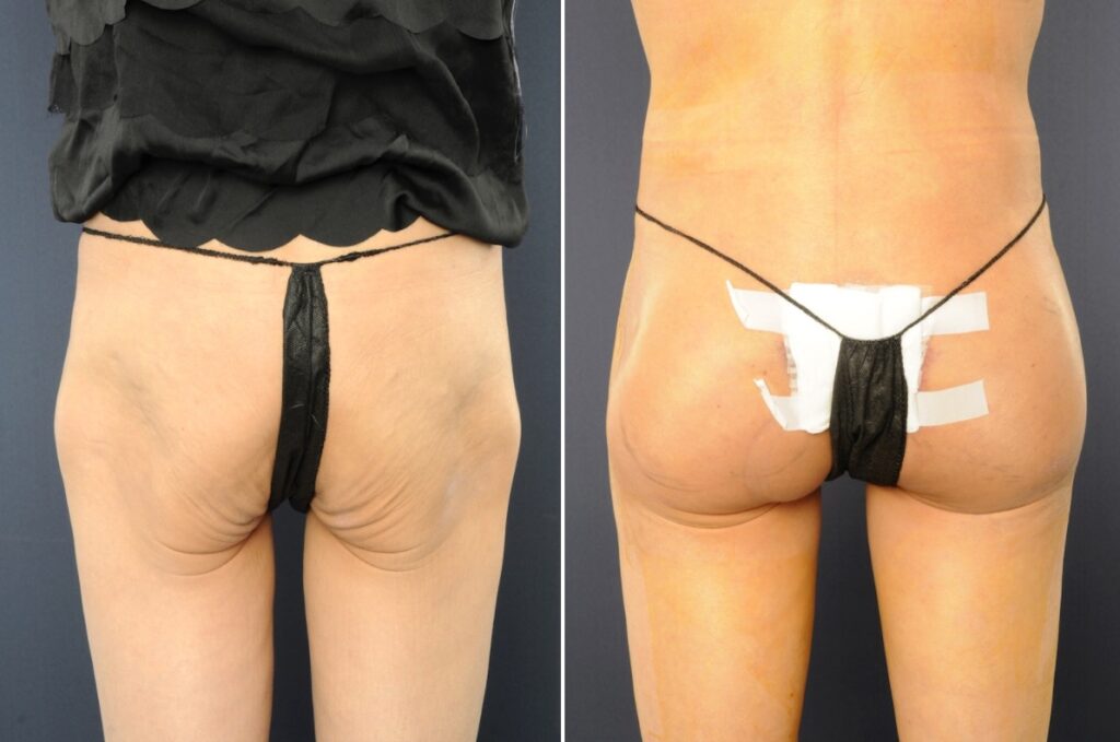 butt implants before and after
