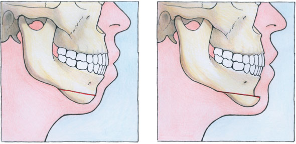 genioplasty before and after