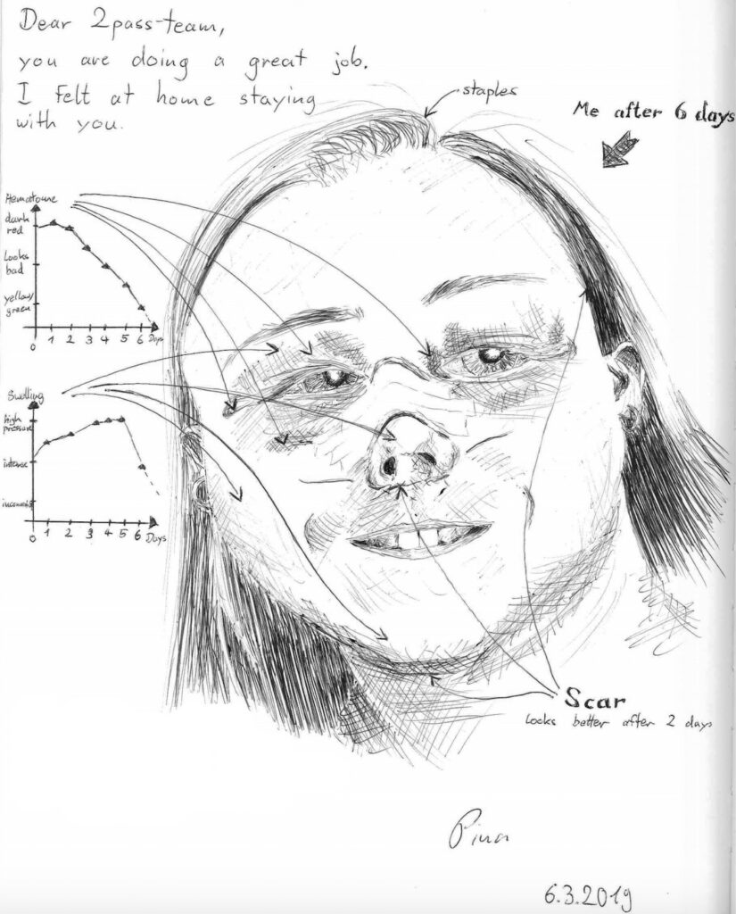 Facial Feminization Surgery