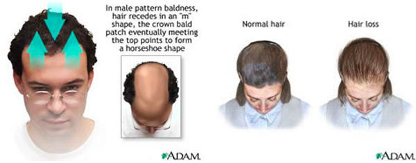 Hairline-aging-pattern