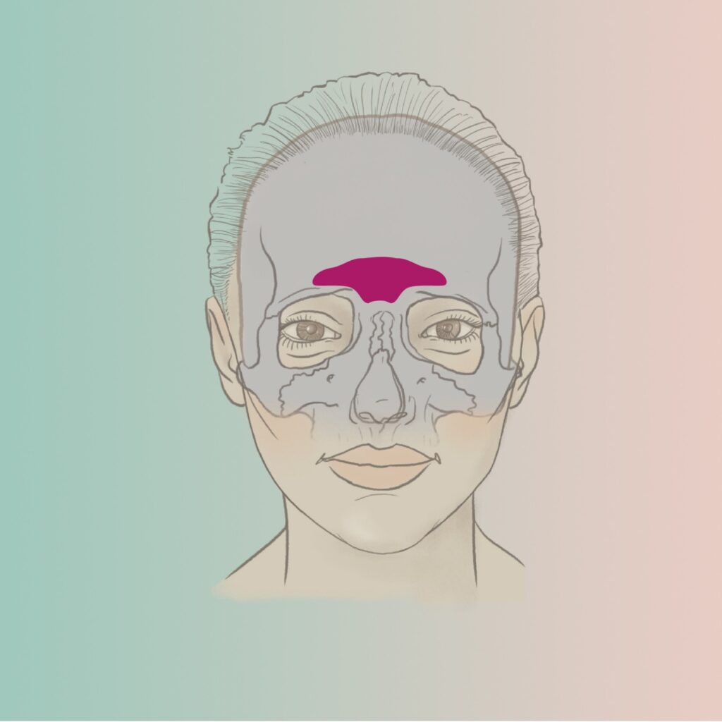 frontal sinus reduction