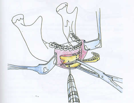 procedure genioplasty