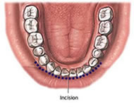 incision genioplasty