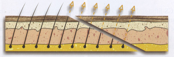 incision hairline lowering