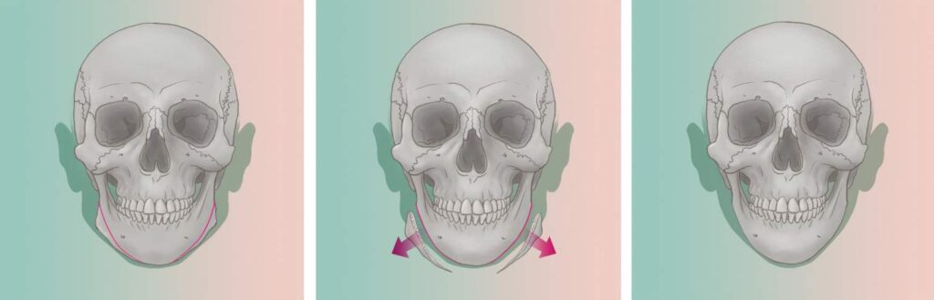 male and female jaw reduction