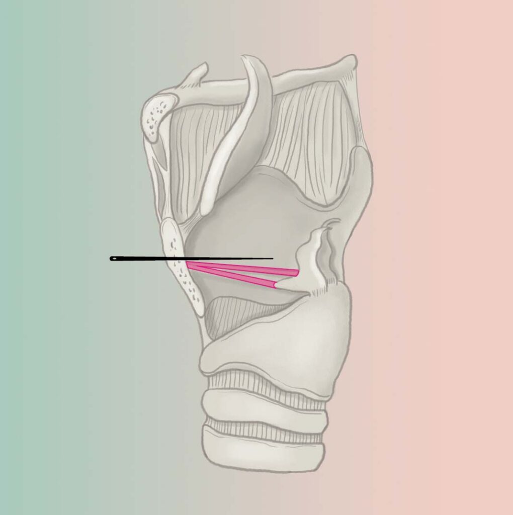 tracheal shave preperation