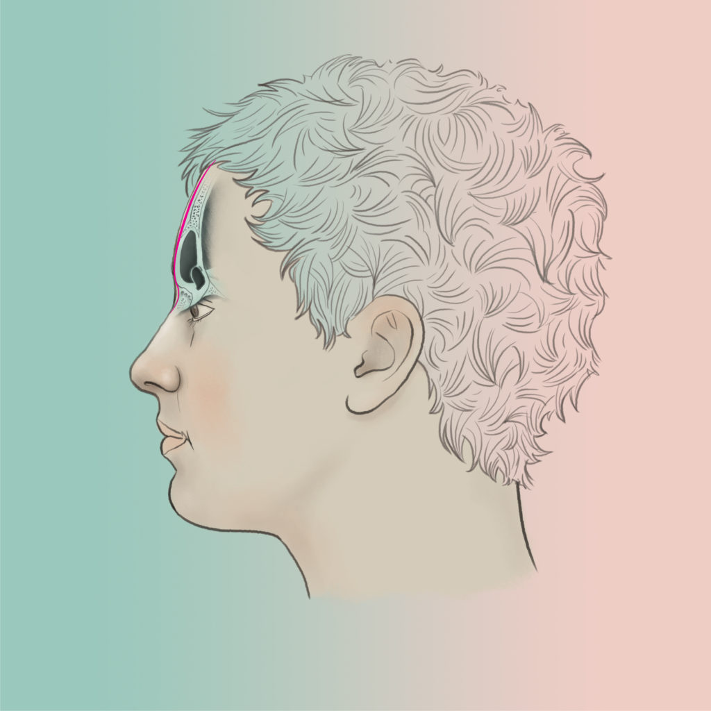 frontal bossing type 3