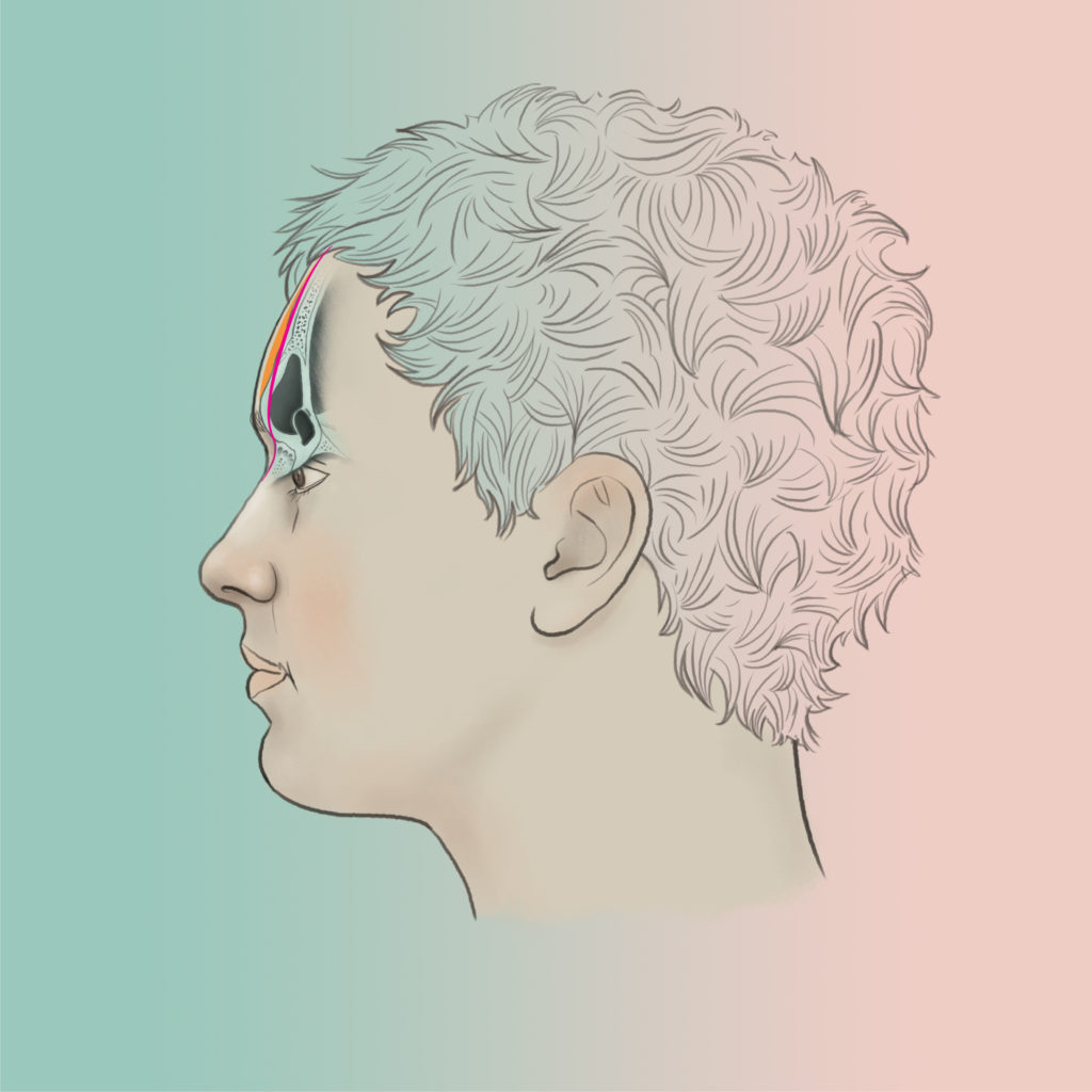 Bad forehead recontouring type 2