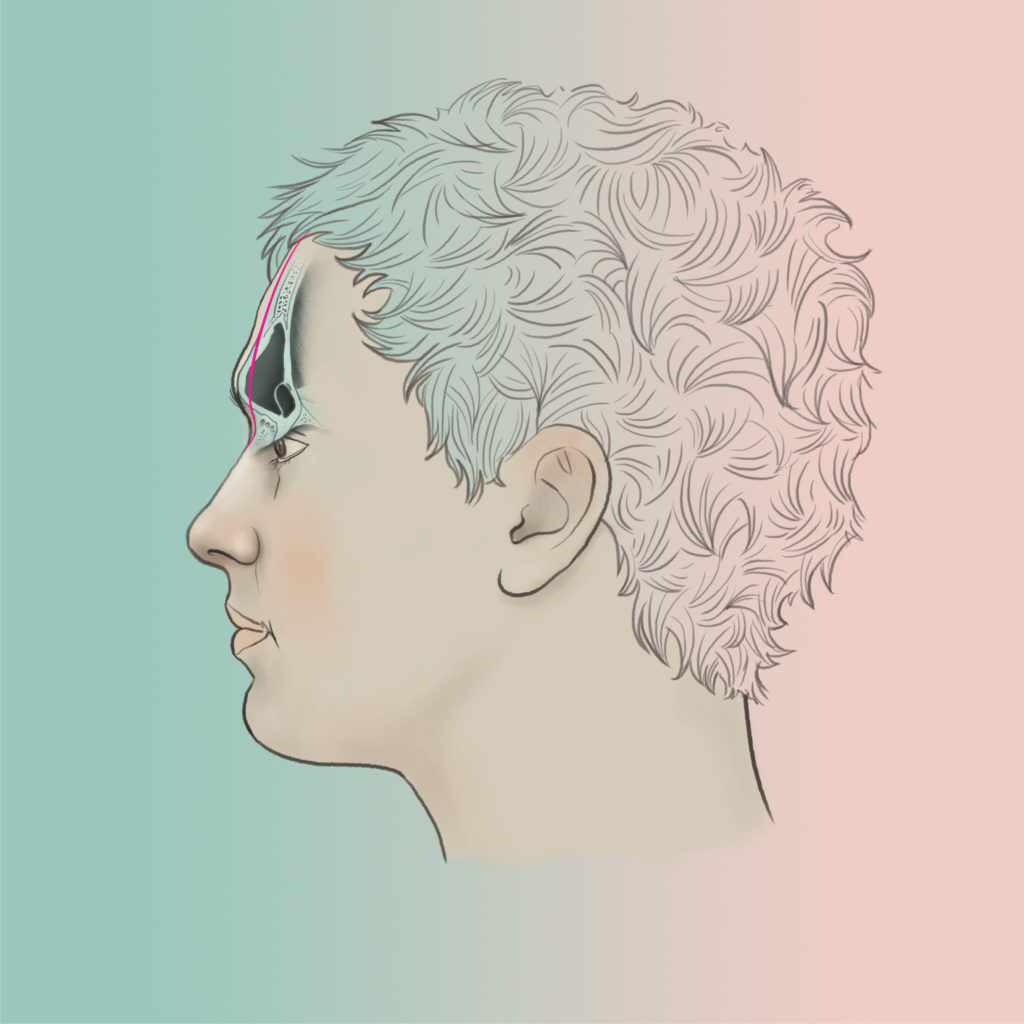 Forehead recontouring and brow bone reduction type 3