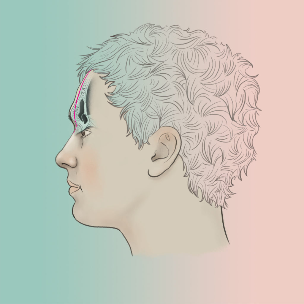 Forehead recontouring type 1