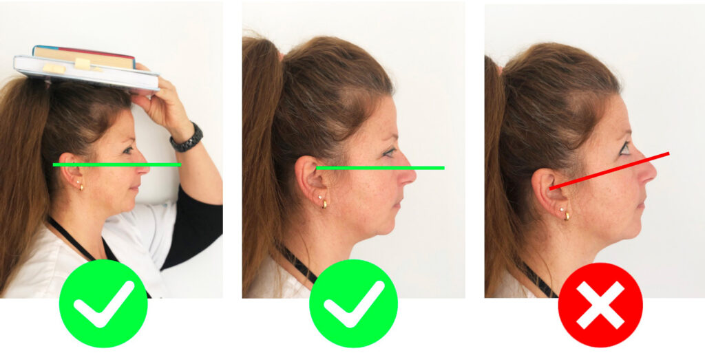 Facial Feminization Surgery