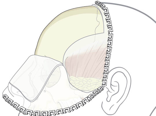 Recontouring voorhoofd