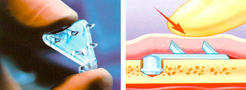 Recontouring voorhoofd