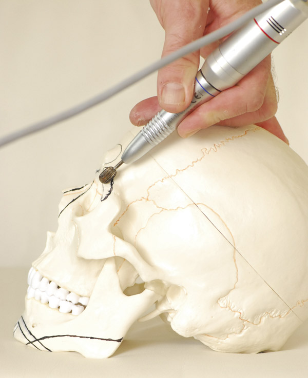 forehead recontouring