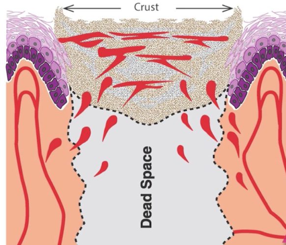Permanente haarverwijdering