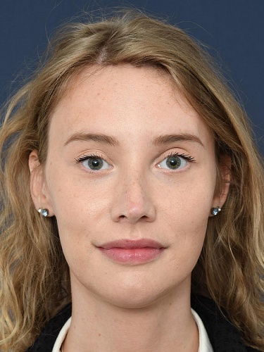 Nicky's FFS verhaal: ontdek haar vlogserie 4 Nicky's FFS verhaal: ontdek haar vlogserie