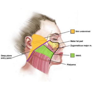 Deep Plane Facelift 9 Deep plane facelift layers
