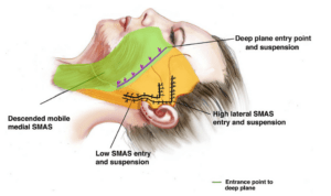 Deep plane facelift lagen
