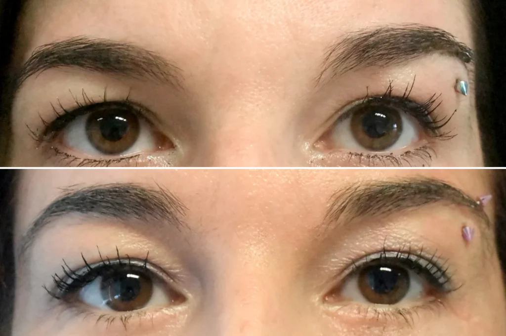 voor en na endoscopische voorhoofdslift